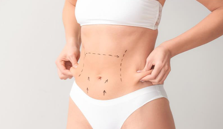 Abdominoplasty