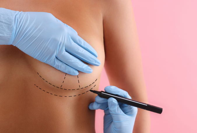 breast surgery